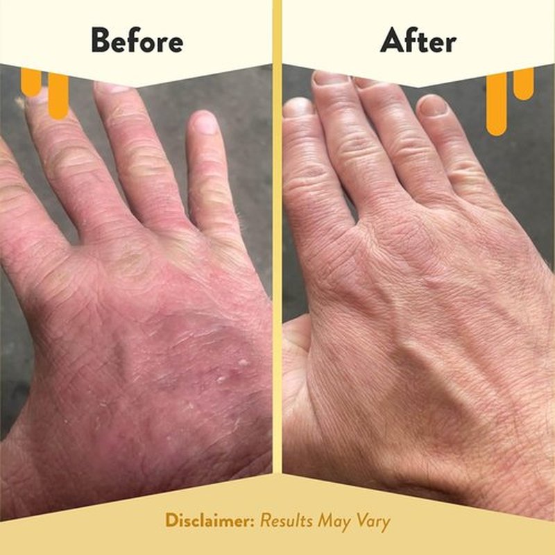 ECZEMA HONEY Gentle Foaming Hand Soap - Non-Toxic, Unscented Cleanser for Dry Hands - 8.4 Oz Organic Honey Wash
