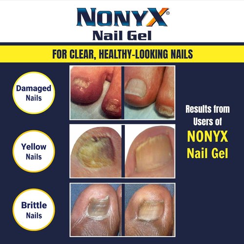 NONYX Fungal Nail Clarifying Gel - Clinically Proven Treatment for Discolored & Brittle Toenails | 90% Improvement Rate