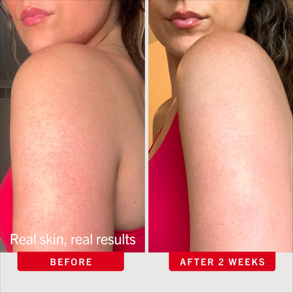 First Aid Beauty KP Bump Eraser Body Scrub with 10% AHA - Dermatologist-Tested Keratosis Pilaris Exfoliator - Support for Rough Bumps, Uneven Skin Texture & Strawberry Skin - Sensitive Skin - 10 oz