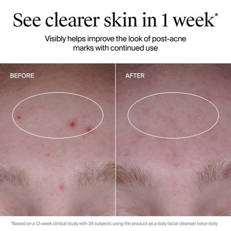 Neutrogena Evenly Clear Acne Cleanser with 2% Salicylic Acid & 2% PHA Exfoliant, Gentle Foaming Face Wash Clears Clogged Pores & Blackheads While Visibly Fading Look of Post-Acne Marks, 9.1 fl. oz