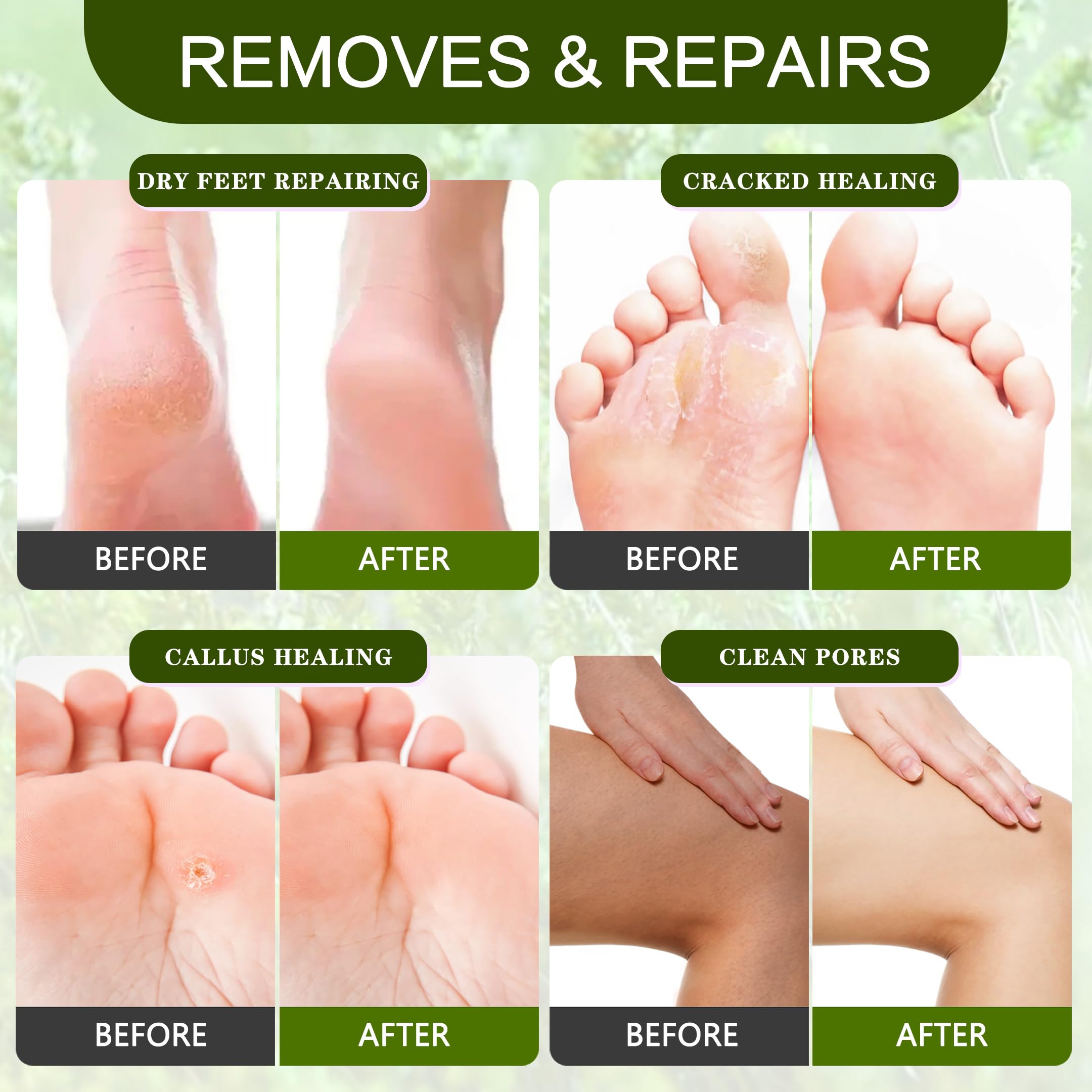 XIWEIOO Foot Callus Remover Gel Kit Heel Exfoliator Dead Skin Remover Pedicure Foot Spa Products Set Home Pedicure Foot Care Spa Supplies for Rough, Dry, Cracked Skin Cracked Heel, Professional