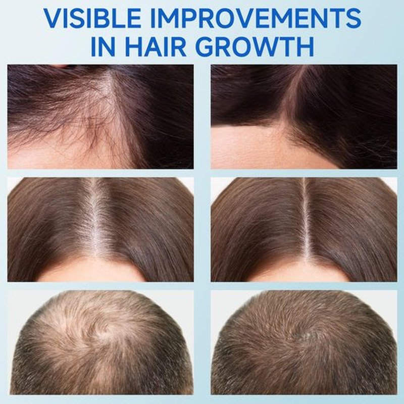 Hair Growth Serum Roll On, Rosemary Oil for Hair Growth, Be Roll On Rosemary Plant Essential Oils Extract Helps Support Body Thicker Fuller Hair for Men Women Pick