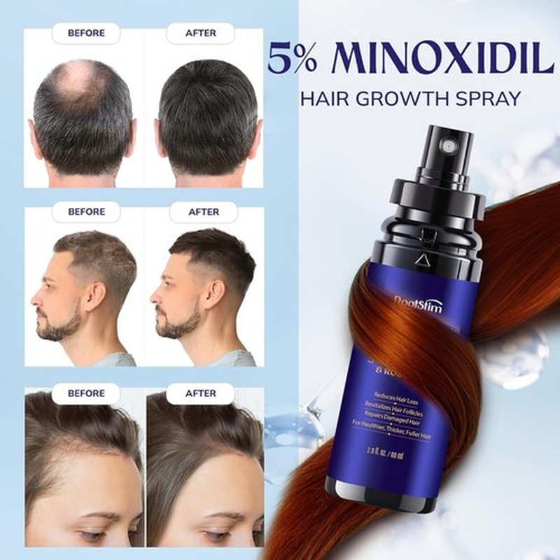 Minoxidil 5% Hair Growth Serum | Extra Strength Treatment for Men & Women - 60ML Each with Rosemary