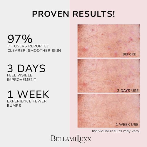 BellamiLuxx Butt Acne Treatment Cream - Clear Folliculitis & Pimples with 2% Salicylic Acid & Tea Tree Oil | Smooth Skin Solution