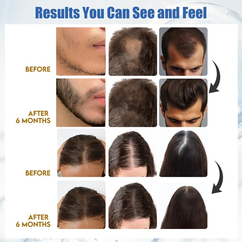Yuaben Minoxidil Foam for Men and Women: 5% Infused with Biotin, Extra Strength, Regrowth Treatments to Combat Hair Loss, Dark Blue