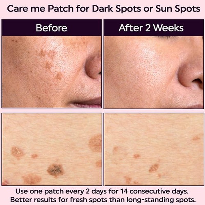 Care Me Microdart Dark Spot Patch - 127 Micropoints for Fading Acne Marks & Dark Spots | 9 Patches