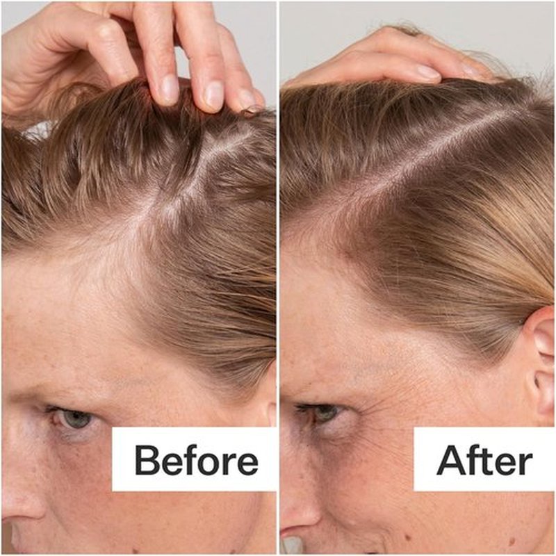 Act+ Acre Cold Processed Salicylic Acid Exfoliator - Balance & Soothe Scalp Build-Up | Vegan, 2 Fl Oz