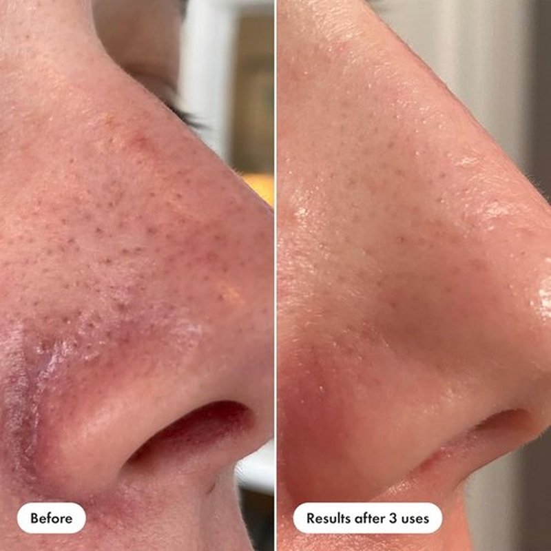 Hero Cosmetics Pore Release Blackhead Clearing Solution - Exfoliating 2% Salicylic Acid Toner | 100 ml