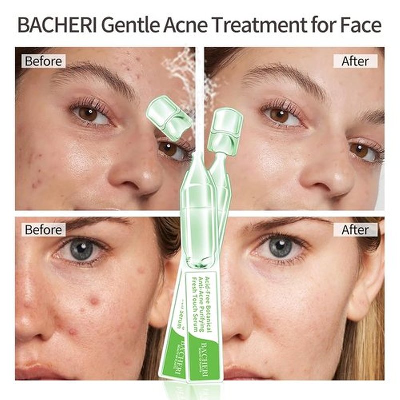 **Gentle Botanical Acne Treatment - Acid-Free Facial Serum with Niacinamide & Witch Hazel | Soothes Redness & Controls Breakouts - 1.2 ml × 30 Ampoules**