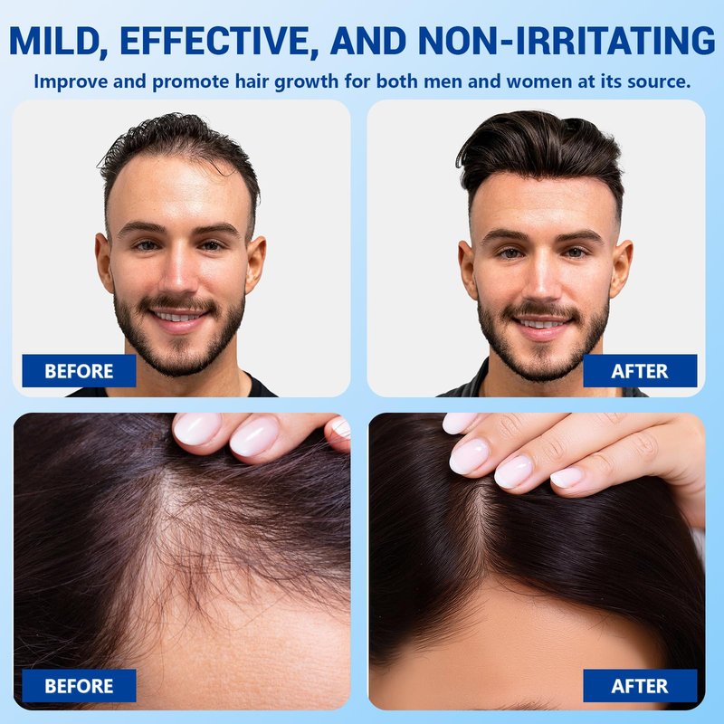 YUFUY Hair Growth Serum Roll On 30ML, With 3% Batana Castor 2% Biotin Niacinamide 3% Rosemary Oil for Hair Growth No-Rinse, Fast-Absorbing Scalp Serum For Thinning Hair for Men & Women -1.0 Fl OZ