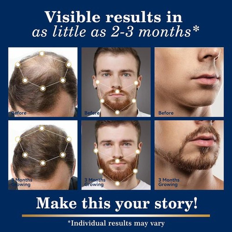 Regine Switzerland 5% Minoxidil Hair Growth Spray Kit - Extra Strength Beard Regrowth Solution | 2PCS