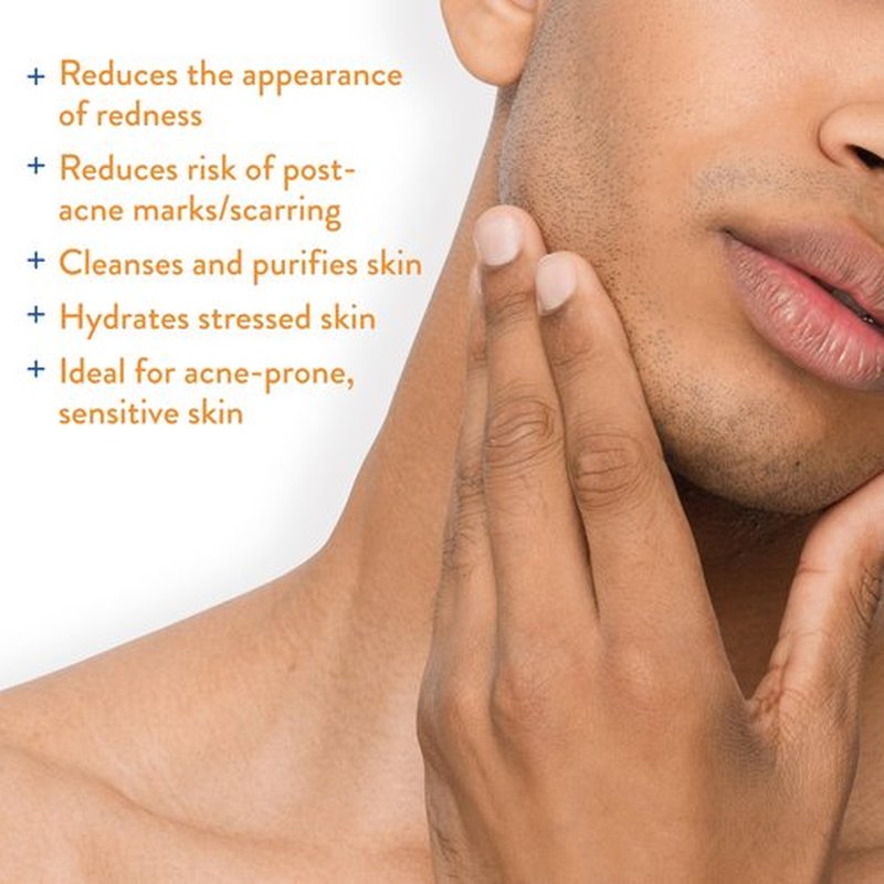AcneFree Hypochlorous Acid Soothing Spray for Face & Body – Redness Relief Mist for Acne-Prone, Sensitive, or Irritated Skin – Gentle Daily Spray for Breakout Support & Skin Barrier Balance – 4 ounce