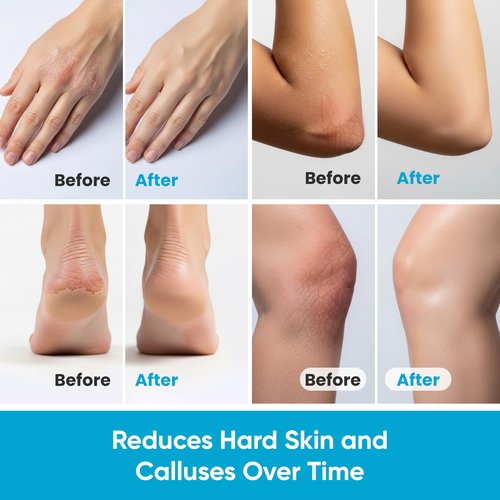 Miratiful Urea Cream 40% plus Salicylic Acid 2% (4 oz)| Urea Cream For Feet Dry Cracked Heels, Knees, Elbows, Hands Callus&Corn Treatment | Urea Foot Cream 40 Percent w/Tea Tree & Coconut Oil