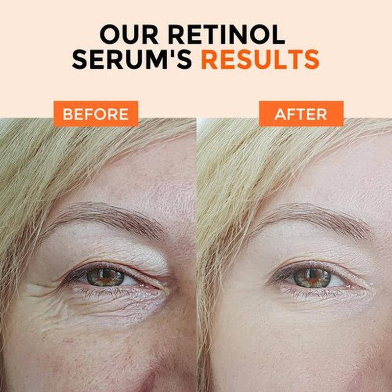 Retinol Serum for Face 2.5%, B5 Resurfacing Retinol Serum with Vitamin C, Vitamin E, Hyaluronic Acid, Niacinamide, Peptide for Anti-Aging, Wrinkle Smoothing, Dark Spot Corrector, Brighten Dullness