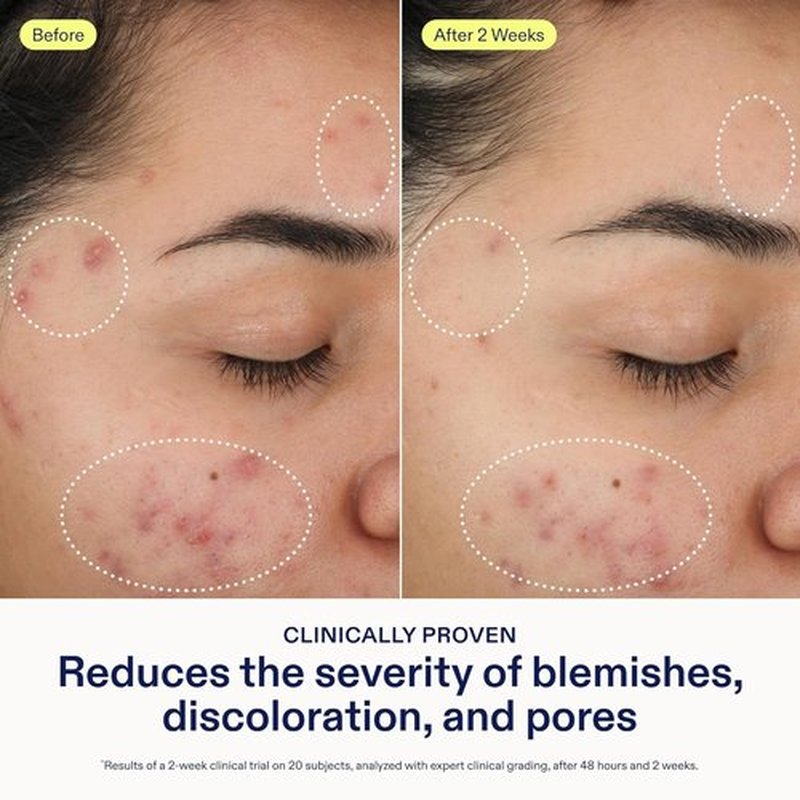 Skinfix 2% BHA Cleanser - Clears Acne Blemishes & Blackheads - 1 oz - Fragrance-Free, Vegan, Cruelty-Free