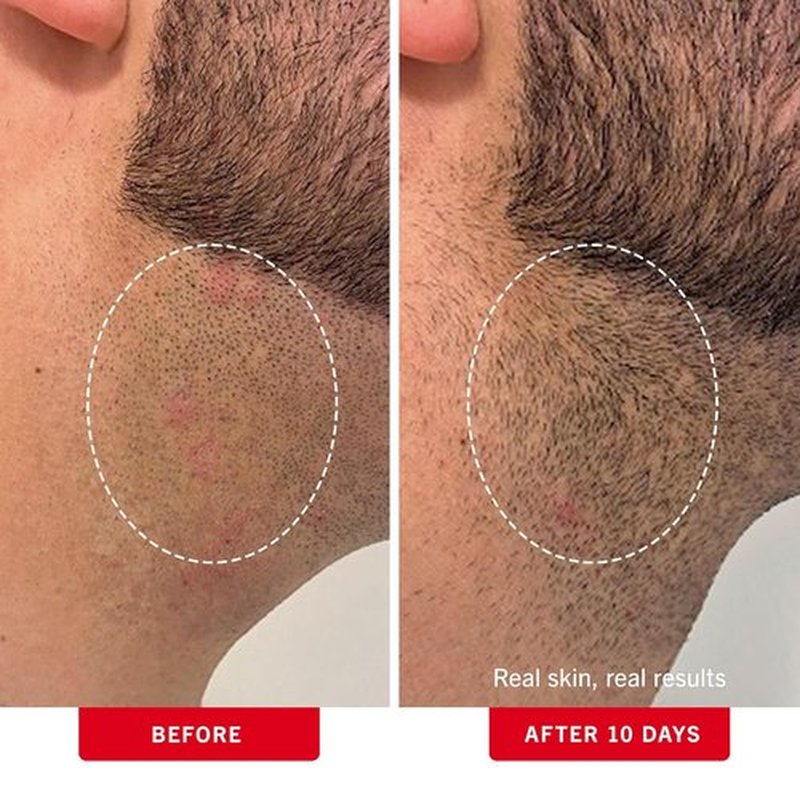 First Aid Beauty - Ingrown Hair Treatment Pads with BHA & AHA - Prevent Razor Bumps for Men & Women - 28 Compostable Pads