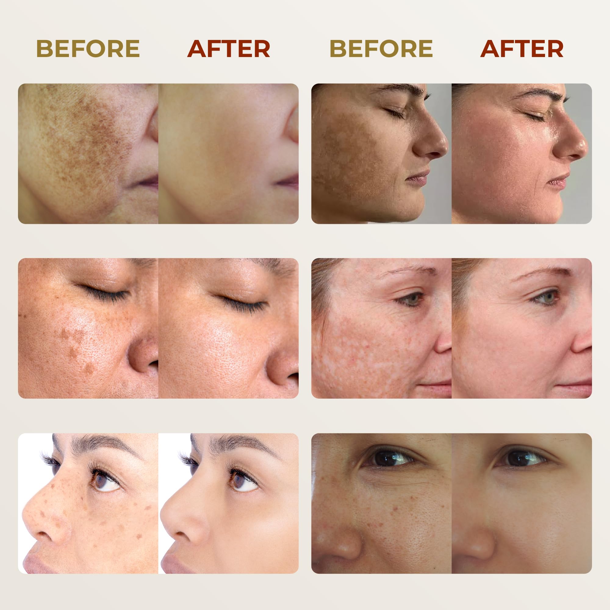 ABERA Melasma Cream, Dark Spot Corrector - Melasma, Freckle, Sun Spot, Age Spot Remover Advanced Formula for Women and Men (3 Boxes)