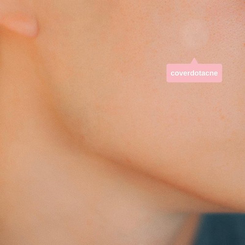SMARTMED Ollie Belle Cover Dot Acne Care Skin Blemish Treatment with Hydrocolloid | Clear, Waterproof Patch (240 dots)
