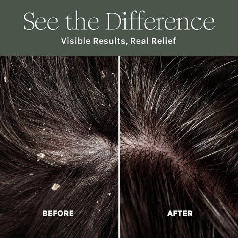 Purist Dandruff Spray - Leave-In Scalp Treatment for Itchy, Dry Skin - Hydrating & Soothing Relief