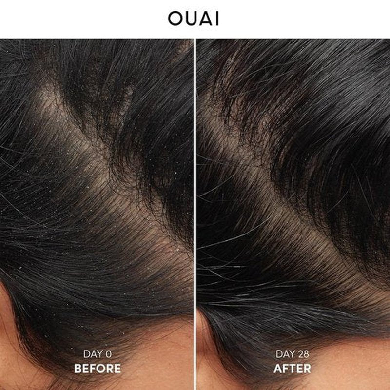 OUAI Anti Dandruff Shampoo - Soothing Salicylic Acid Formula for Flaky Scalp - Reduces Itching & Irritation - 10 Fl Oz
