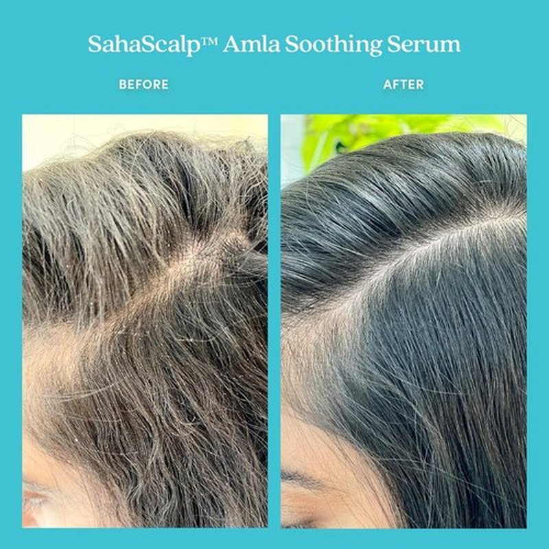 Fable & Mane Amla Soothing Serum - Purifies & Balances Irritation for Dry, Itchy Scalps